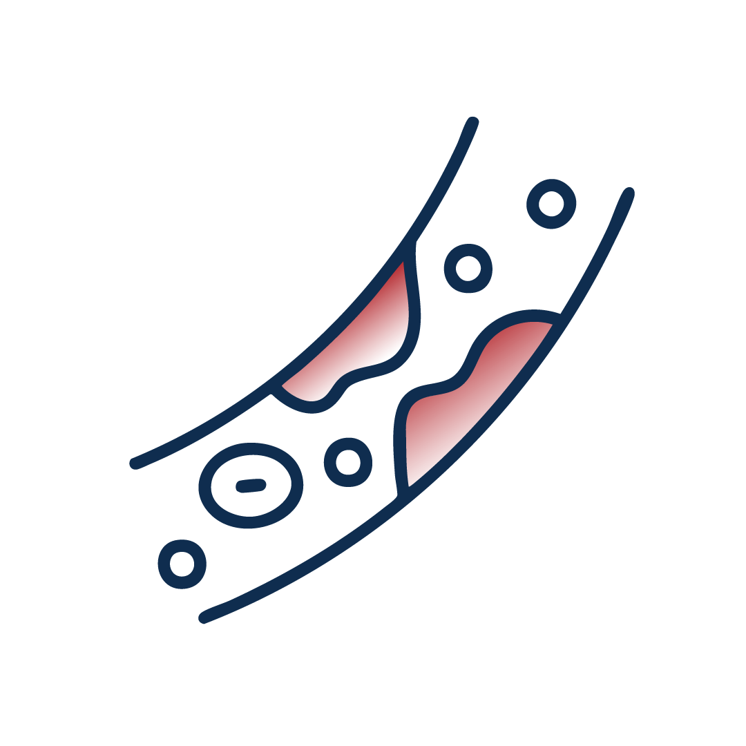 Cholesterin, Atherosklerose